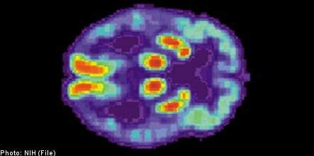Swedish researchers develop Alzheimer's test