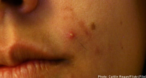 Acne linked to suicide risk: Swedish study
