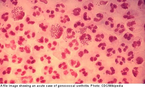 Gonorrhea cases on the rise in Sweden